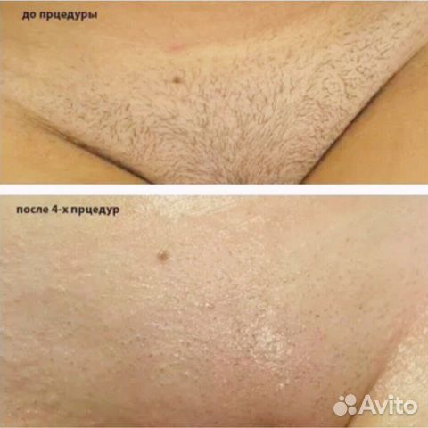 Лазерная диодная эпиляция м.Сокол,м.Панфиловская Лазерная диодная эпиляция м.Сокол,м.Панфиловская