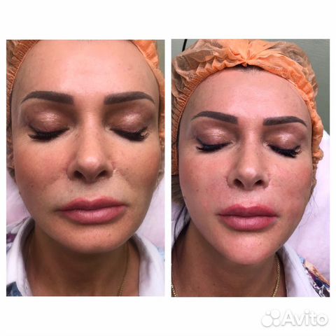 Лифтинговая процедура Фул фэйс Лифтинговая процедура Фул фэйс