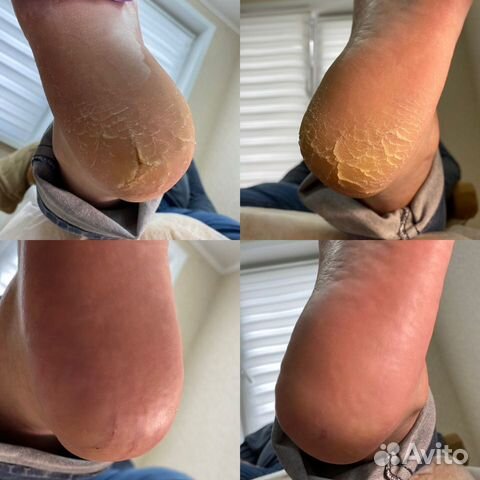 Аппаратный педикюр.Лечение вросшего ногтя, установ